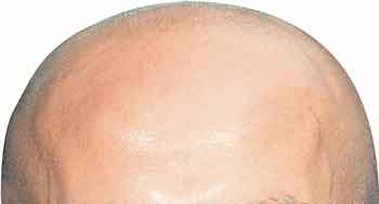 bald head